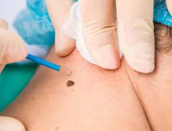 What Is the Price of Moles Removal Treatment?