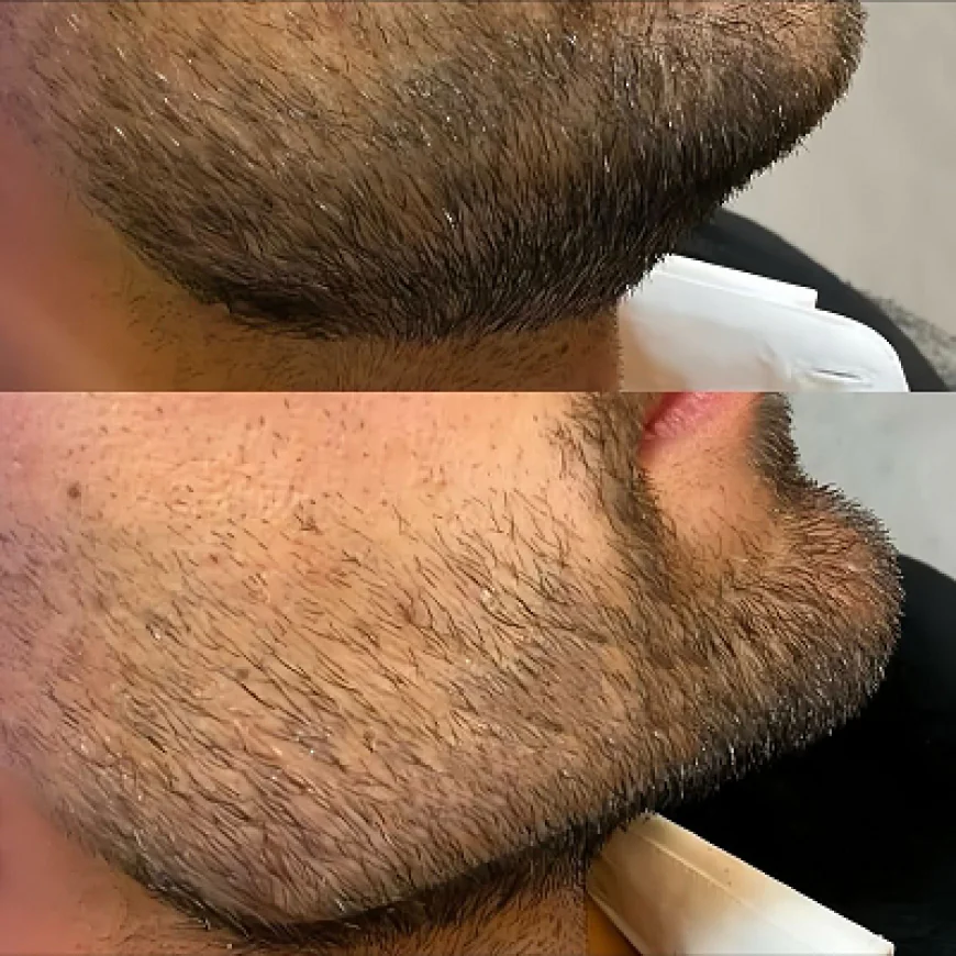 Beard Hair Transplant in Dubai: A Proven Solution