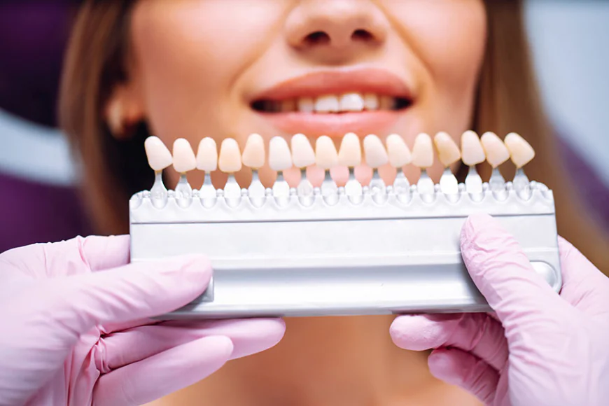 Ceramic Crowns for Front Teeth: A Complete Guide