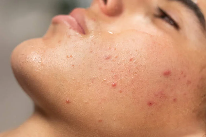 Can Acne Treatment reduce acne scars safely