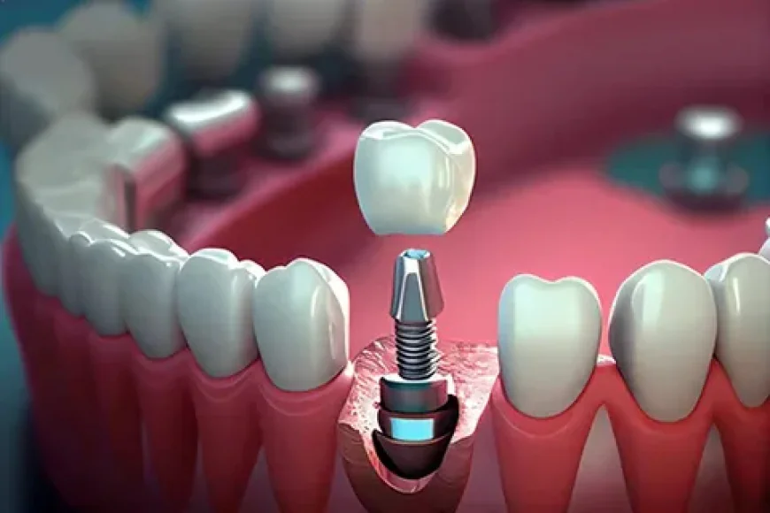 Dental Implant Treatment in NIBM Pune |Restore Your Smile with DR. BILAL'S DENTAL CLINIC