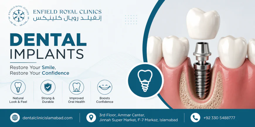 Dental Implants Are the Best Long-Term Solution for Missing Teeth: