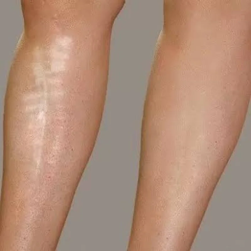 Leg Laser in Dubai Procedure Explained – Step-by-Step Guide for Smooth Skin