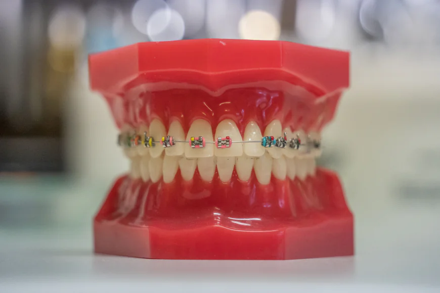 Discreet Smile Correction: Modern Solutions for Straighter Teeth