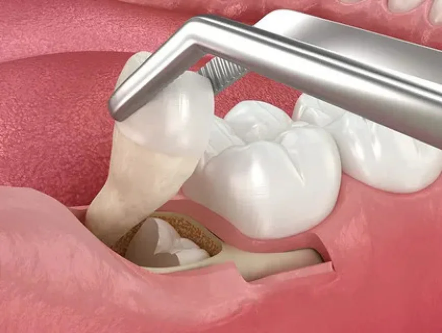 Looking for Tooth Extraction in NIBM Pune? Choose Safe & Comfortable Care