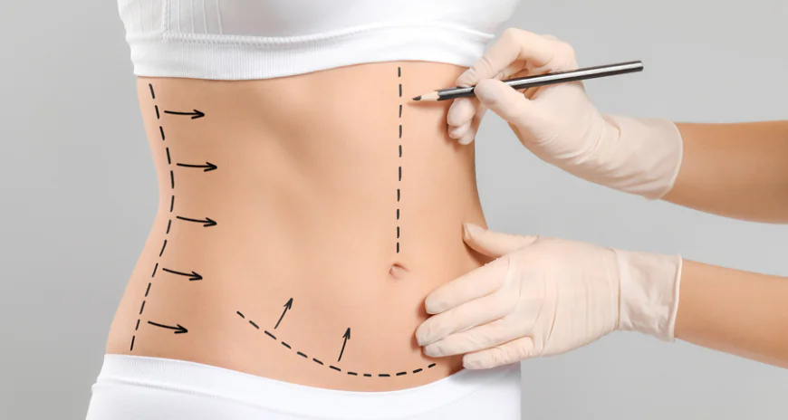 Liposuction in Riyadh for Removing Stubborn Fat Deposits