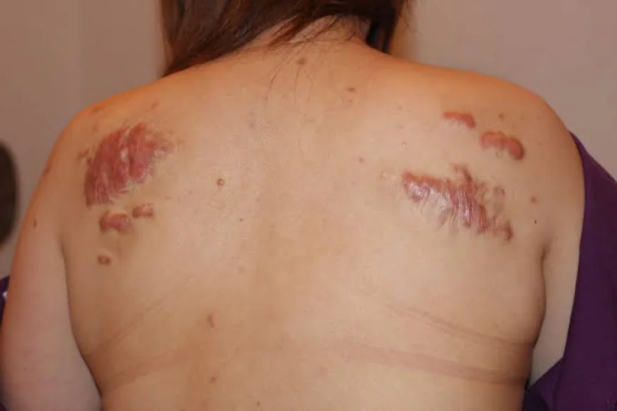 How Does Keloid Treatment Reduce Scars?