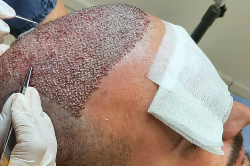Is FUE Hair Transplant Safe for All Age Groups?