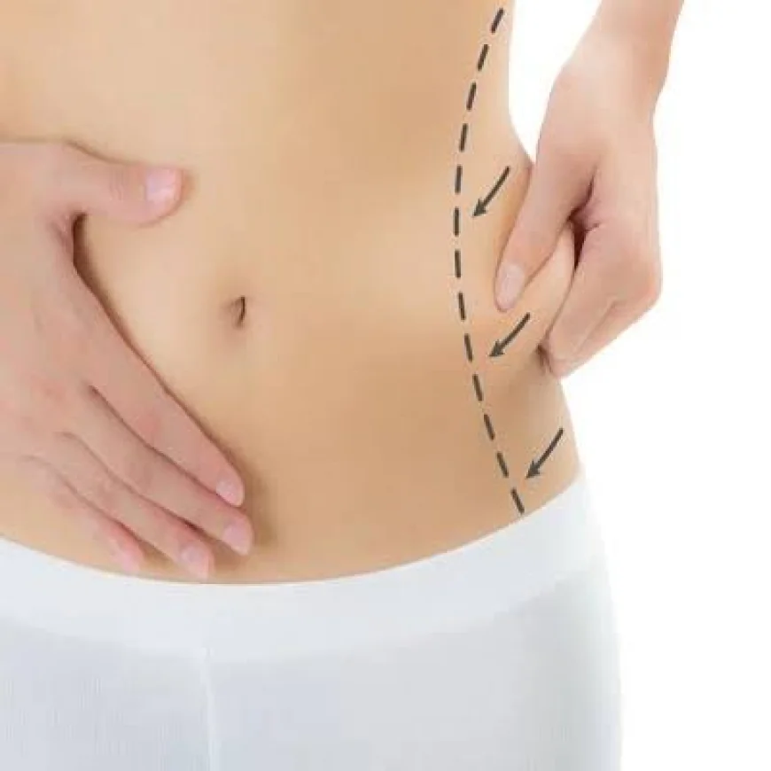 Liposuction Surgery in Dubai: A Complete Guide to Body Contouring and Lasting Confidence