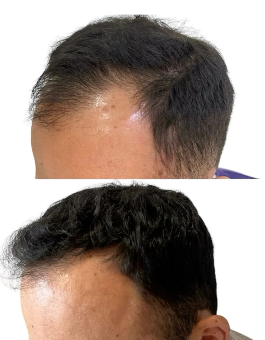 The Science of Scarless Hair Restoration in Dubai