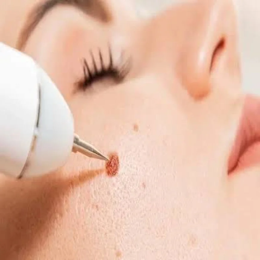 Remove Warts from Face in Dubai: Safe and Effective Ways to Achieve Clear Skin