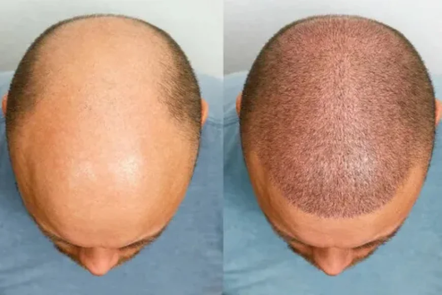 Crown Hair Transplant in Dubai: Restore Your Confidence