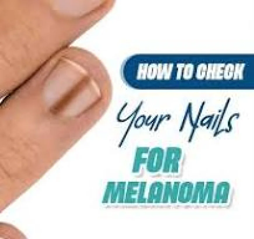 How to Inspect Nails for Melanoma Cancer