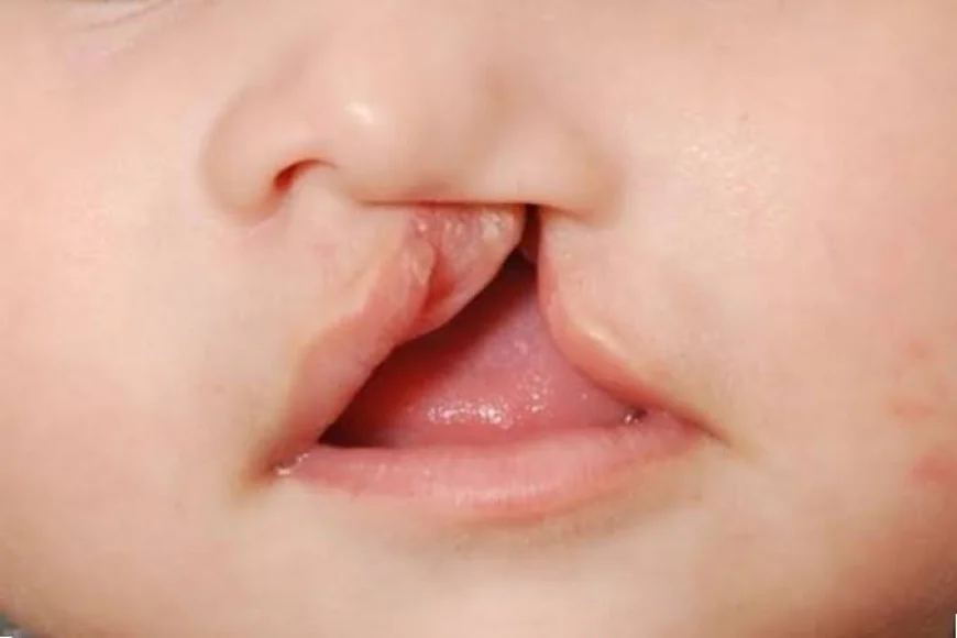 Who Is Eligible for Palate Repair Surgery?