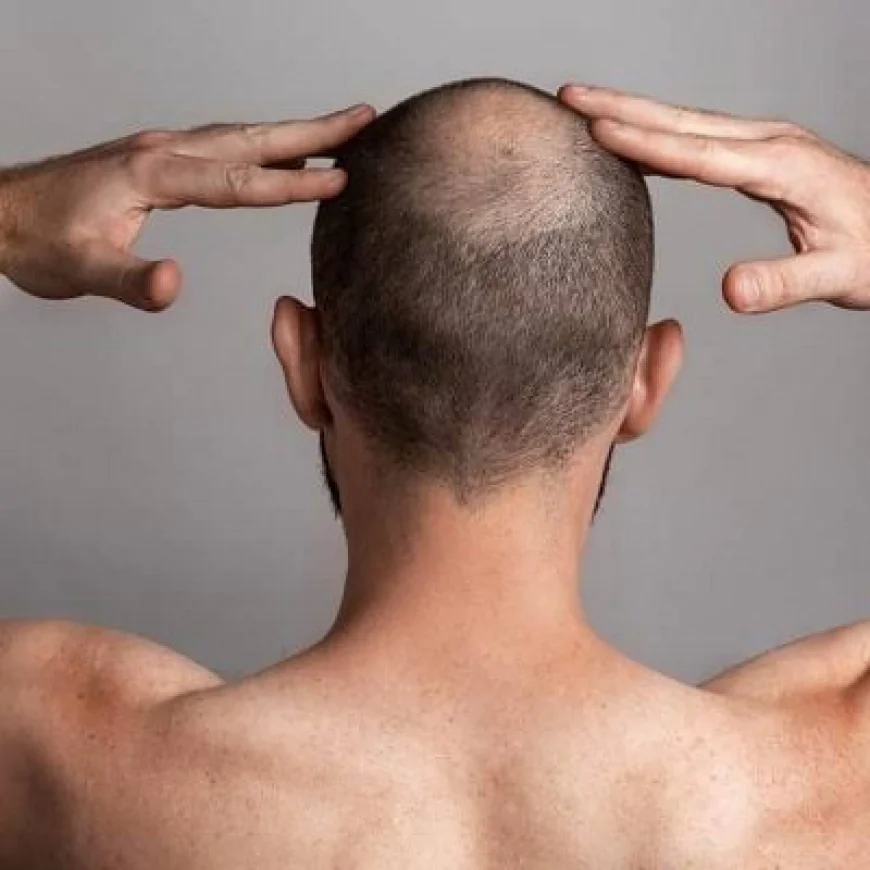 Crown Area Transplant in Dubai | Restore Crown Hair Density Naturally
