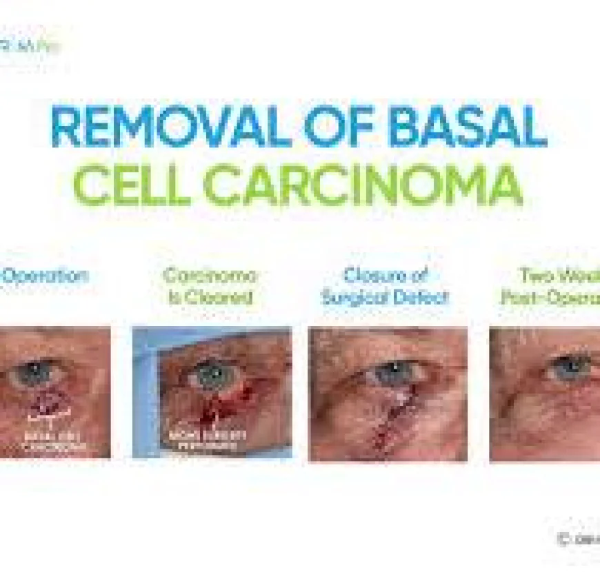 How to Identify and Treat Basal Cell Carcinoma?