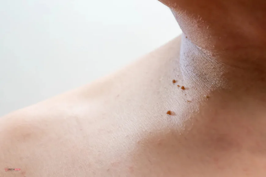 Skin Tag Removal Houston | Expert Skin Care Solutions