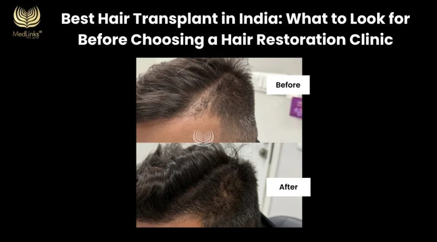Best Hair Transplant in India: What to Look for Before Choosing a Hair Restoration Clinic