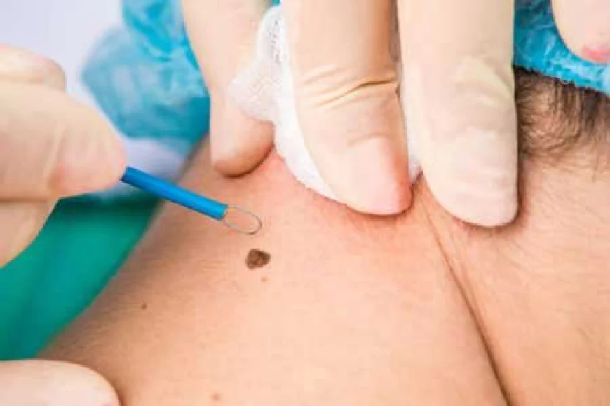 How Is Moles Removal Treatment Performed?