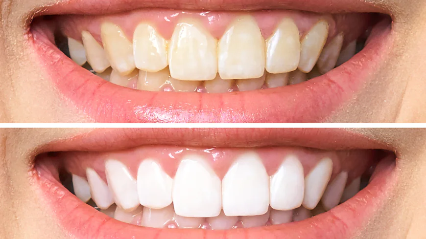 Teeth Cleaning Dubai: Why Regular Checkups Matter