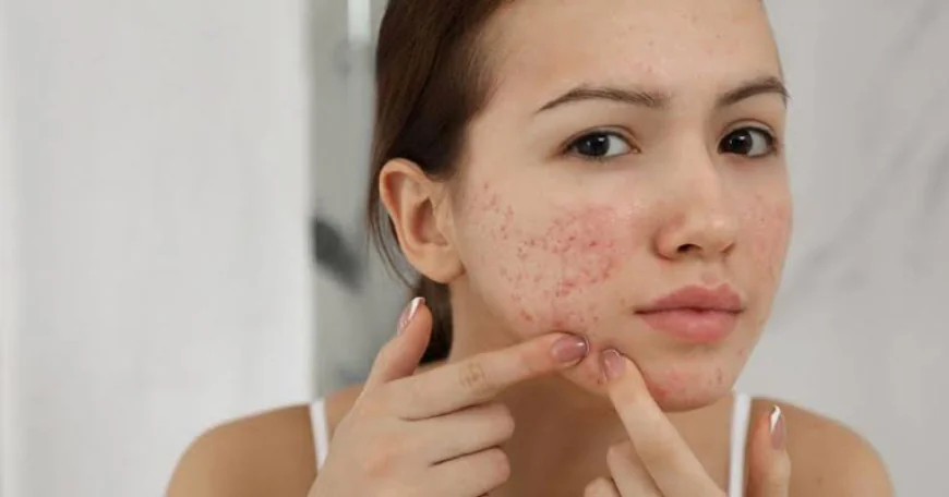 What Are the Benefits of Acne Treatment?