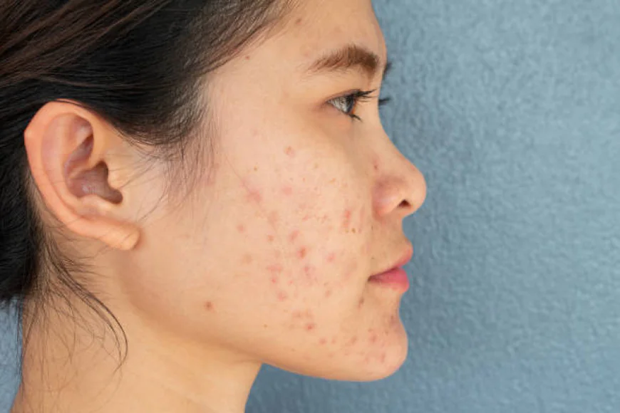 Is Acne Treatment Right for Severe Acne?