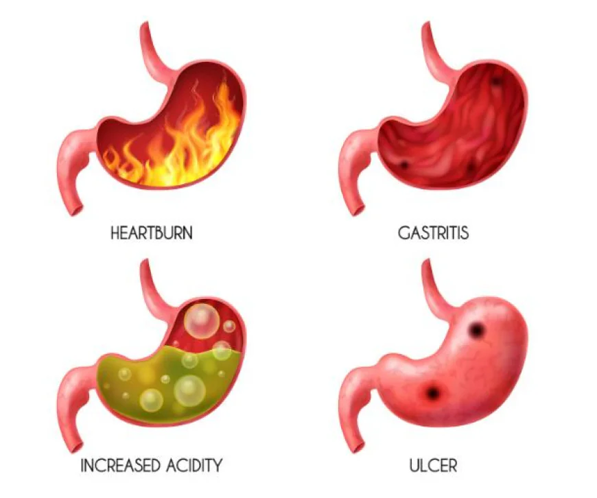 Acute vs. Chronic Gastritis: What's the Difference?