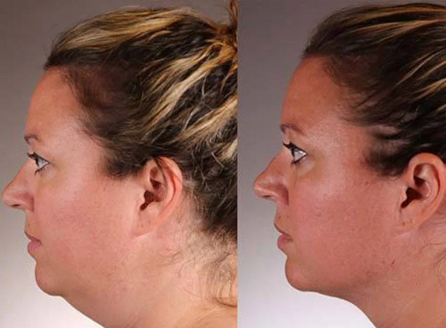 Reversing the Visible Effects of Digital Posture on the Lower Face