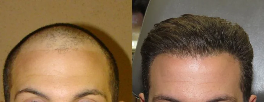 Hair Transplant in Dubai: The Ultimate Guide to Permanent Hair Restoration