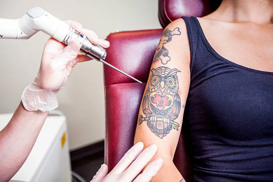 Can Laser Tattoo Removal Remove All Ink Colors