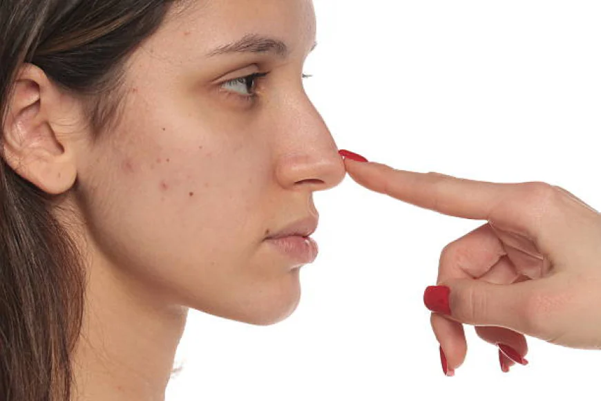 Is Alarplasty Suitable for Every Nose Type?