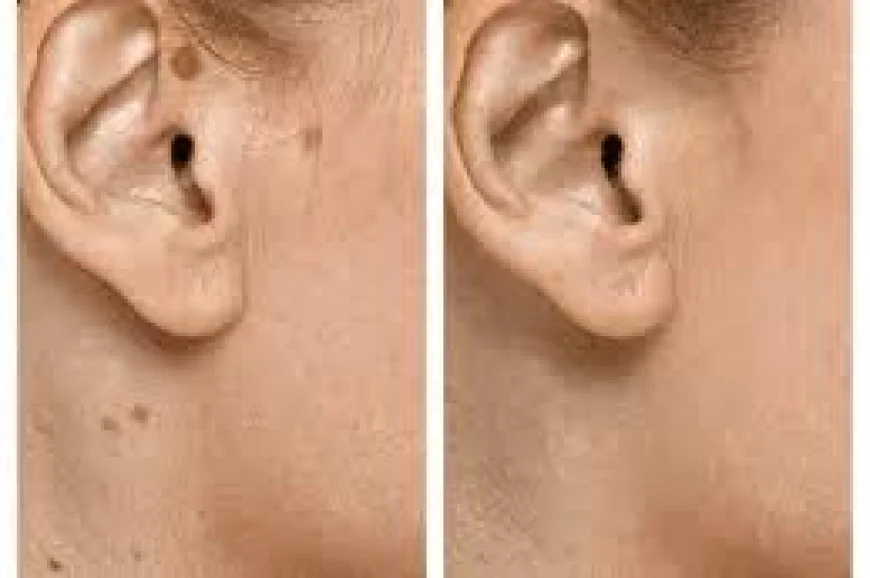 Seborrheic Keratosis Treatment in Dubai | Effective Skin Care Solutions