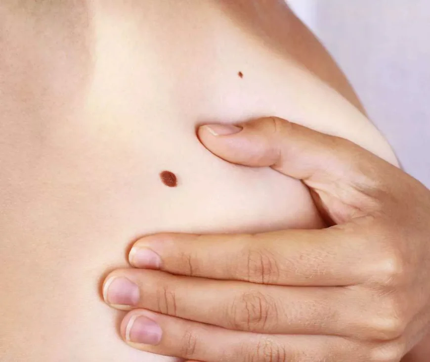 How Skin Tag Removal in Islamabad Has Changed With New Dermatology Methods
