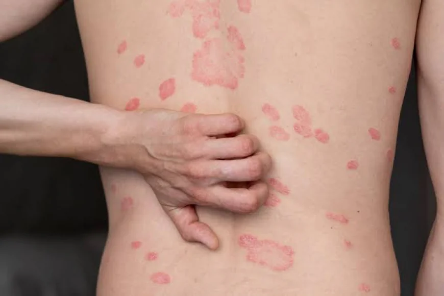 Ayurvedic Treatment for Plaque Psoriasis: Restore Skin Health Naturally with Ayurveda