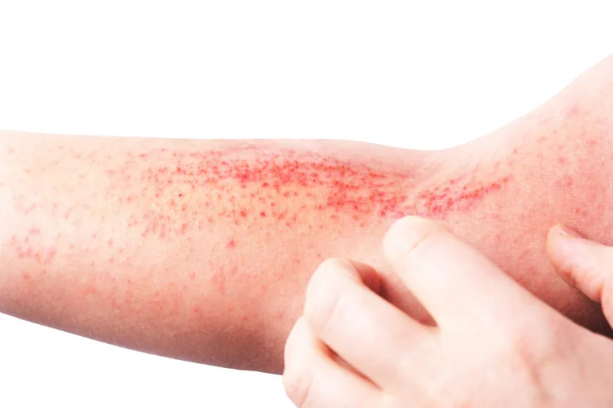 What Are the Best Treatment Options for Skin Infections?