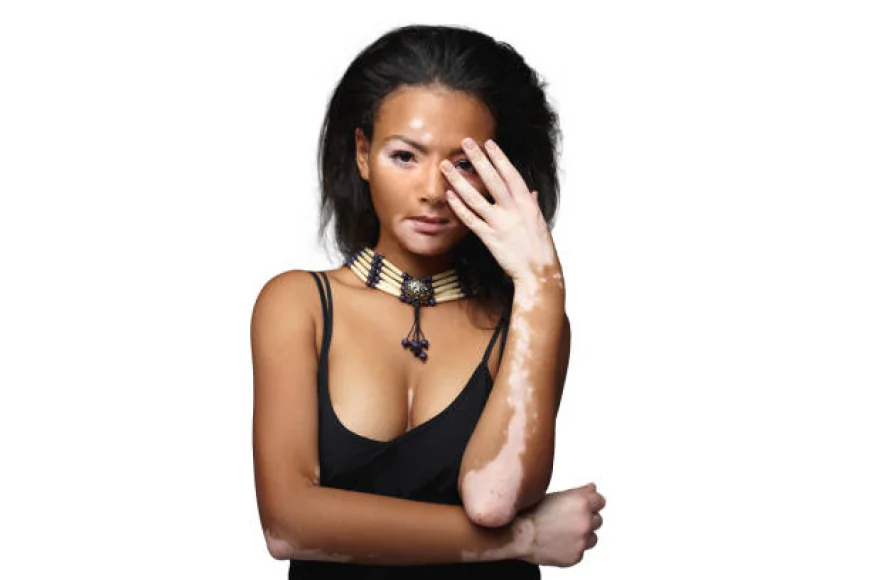 How Does Vitiligo Treatment Improve Appearance?