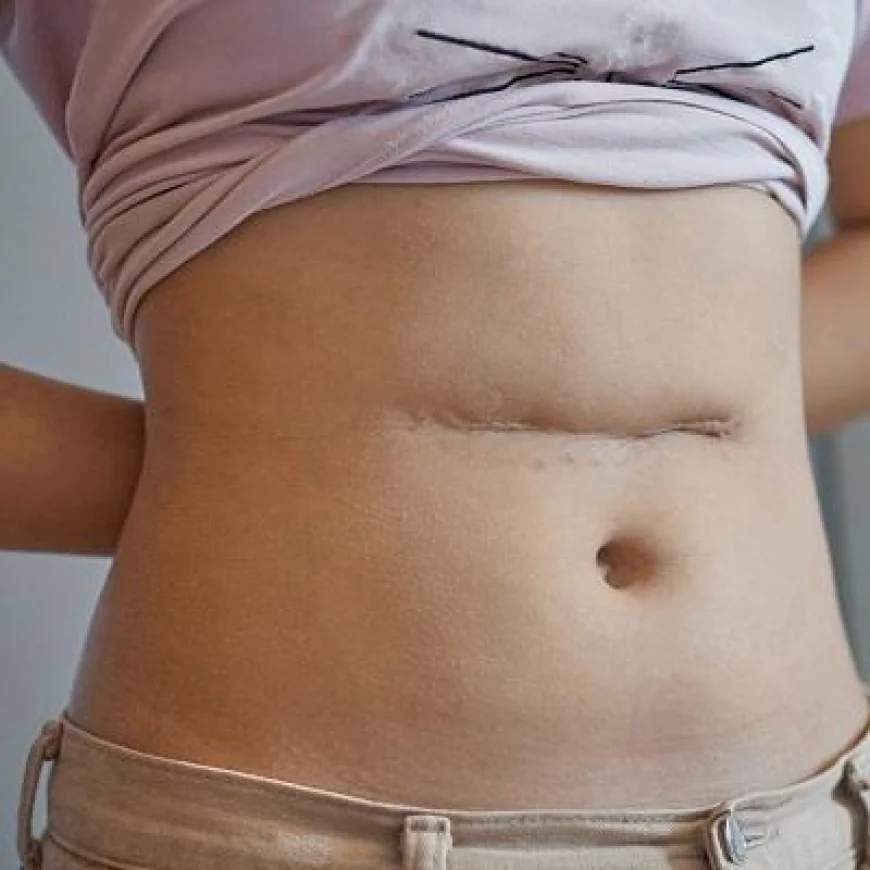 How Does Surgical Scar Revision Treatment Work?