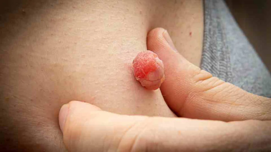 What Are the Benefits of Skin Tag Removal?