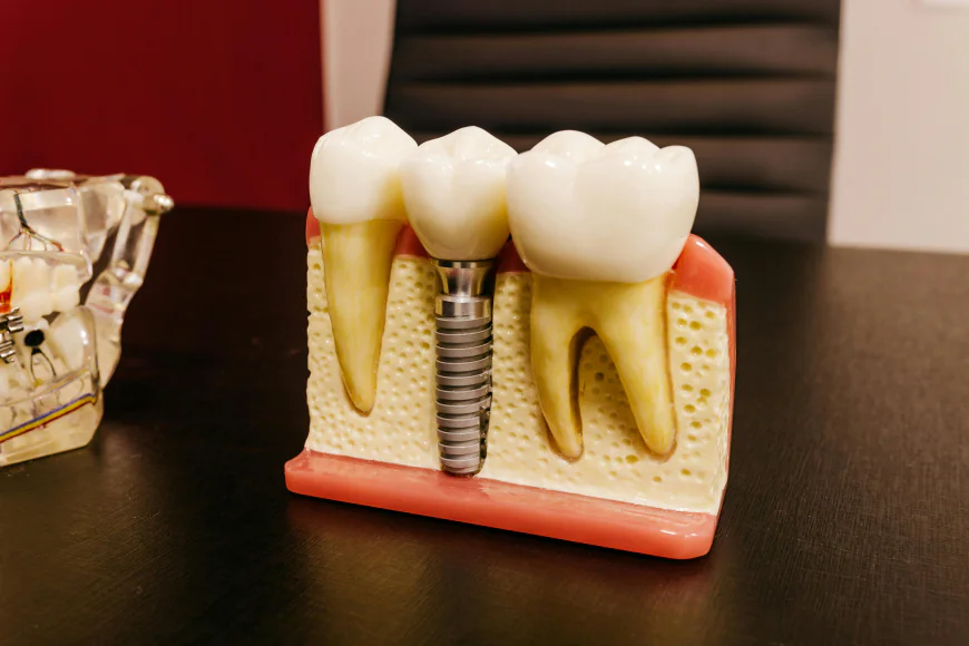 Dental Implants Oxnard CA: Your Complete Guide to a Confident Smile