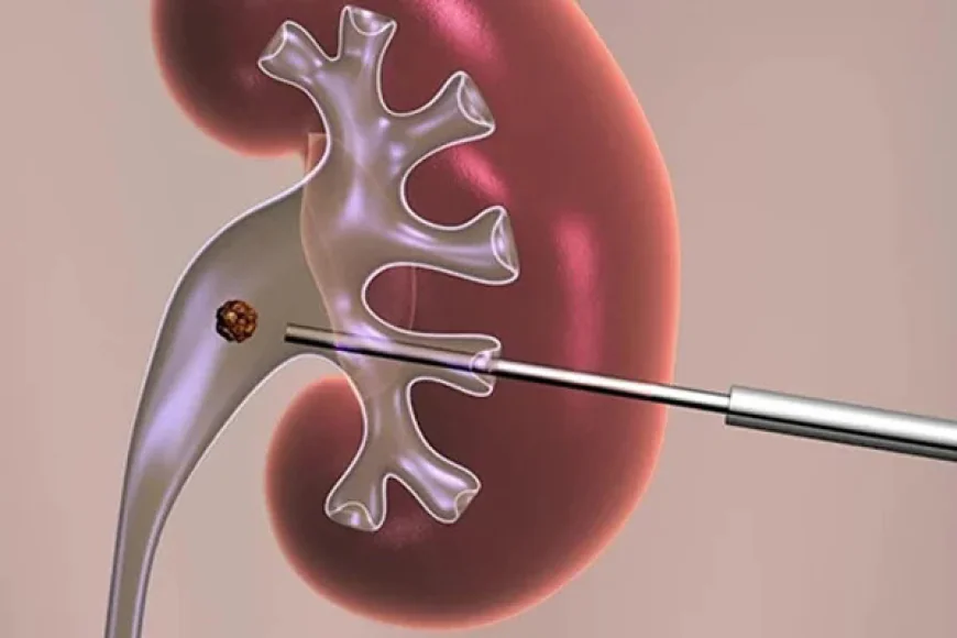 PCNL Surgery in Gurgaon: An Effective Treatment for Large Kidney Stones