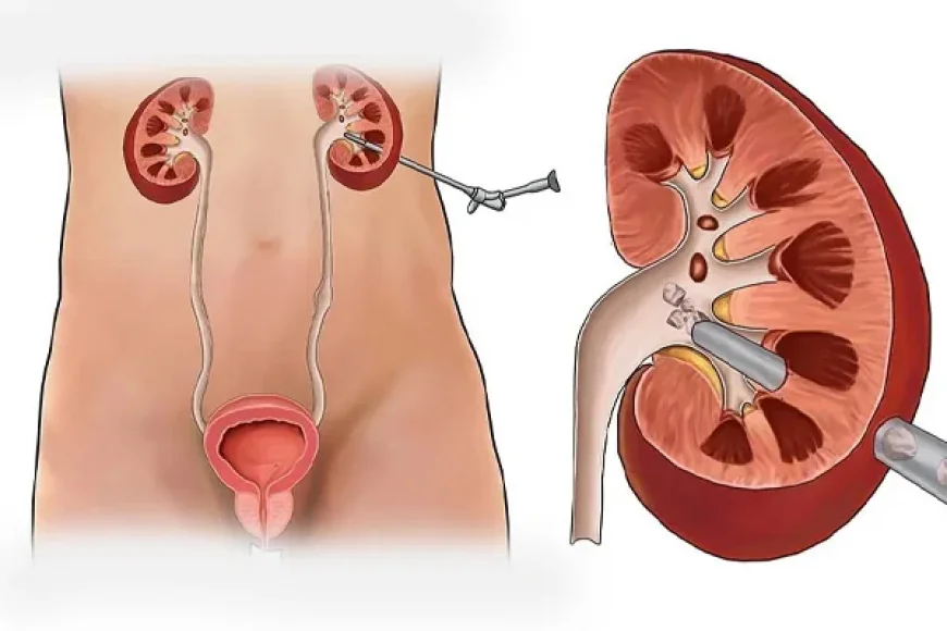 Mini PCNL Surgery in Gurgaon: A Modern Approach to Treating Kidney Stones
