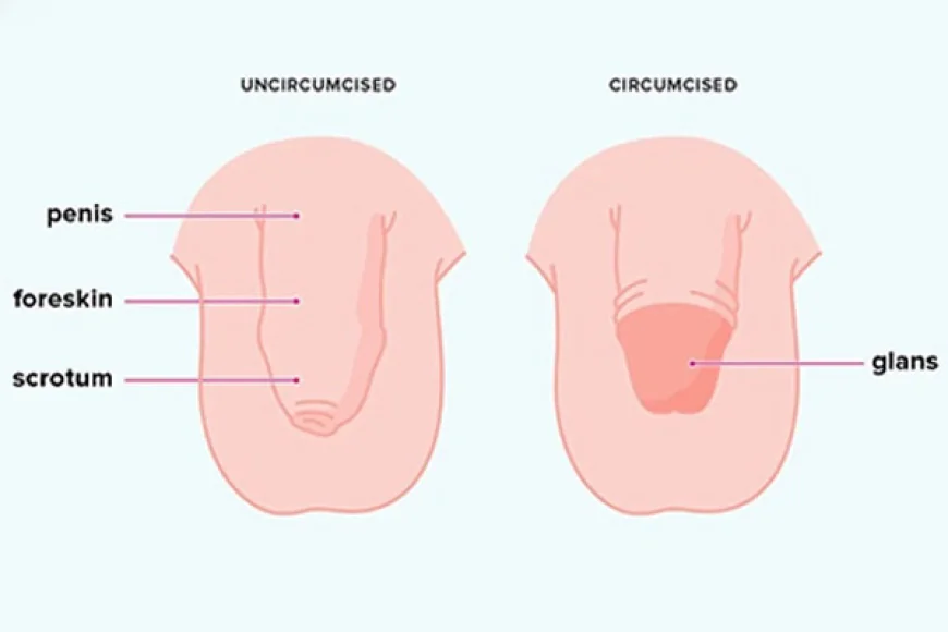 Circumcision Surgery in Gurgaon: Safe and Modern Surgical Care by Dr. Ankit Gupta
