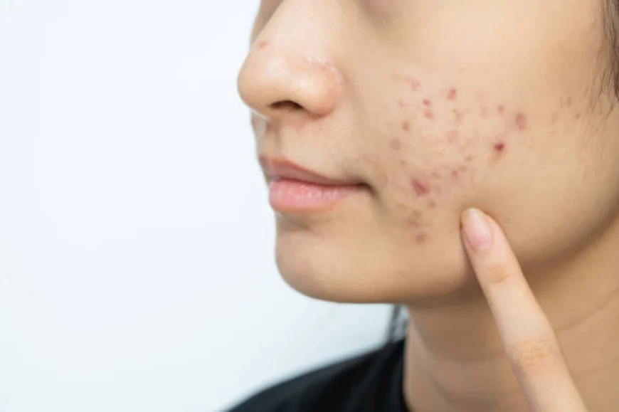 Can Laser Acne Scar Treatment Reduce Pits?