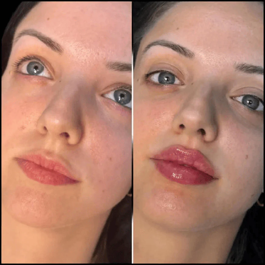 Enhancing Beauty with the Best Aesthetic Clinic in dubai for Fillers