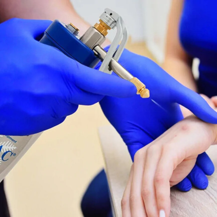 How Many Cryosurgery Sessions Are Usually Needed?