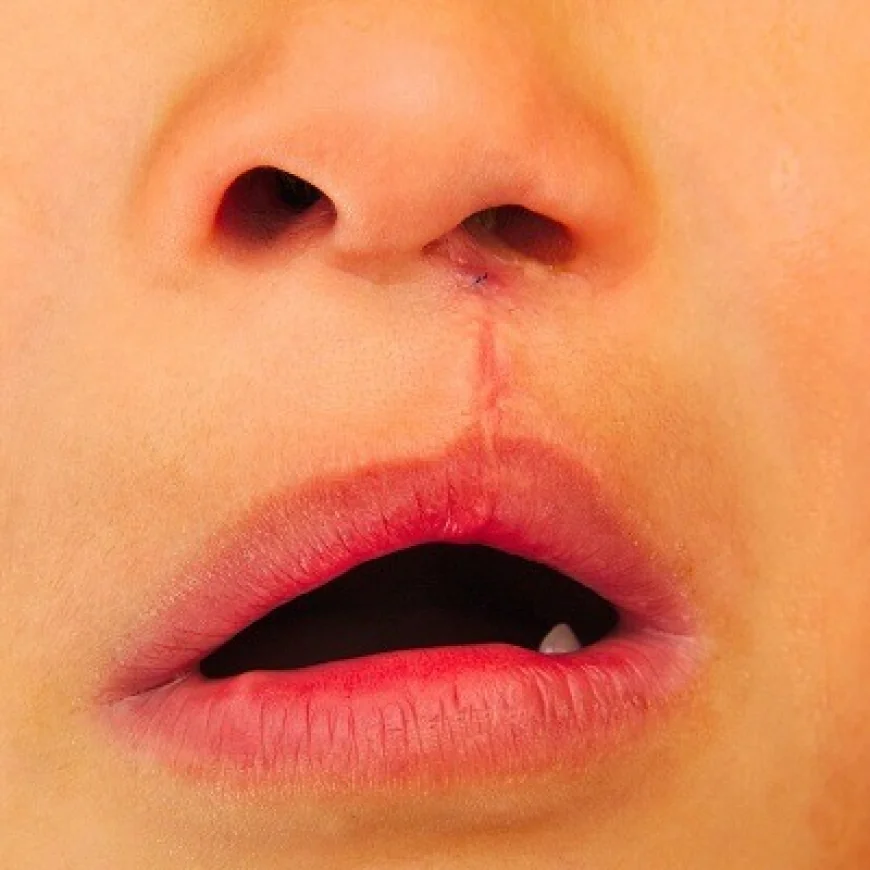 Who Is Eligible for Palate Repair Surgery?