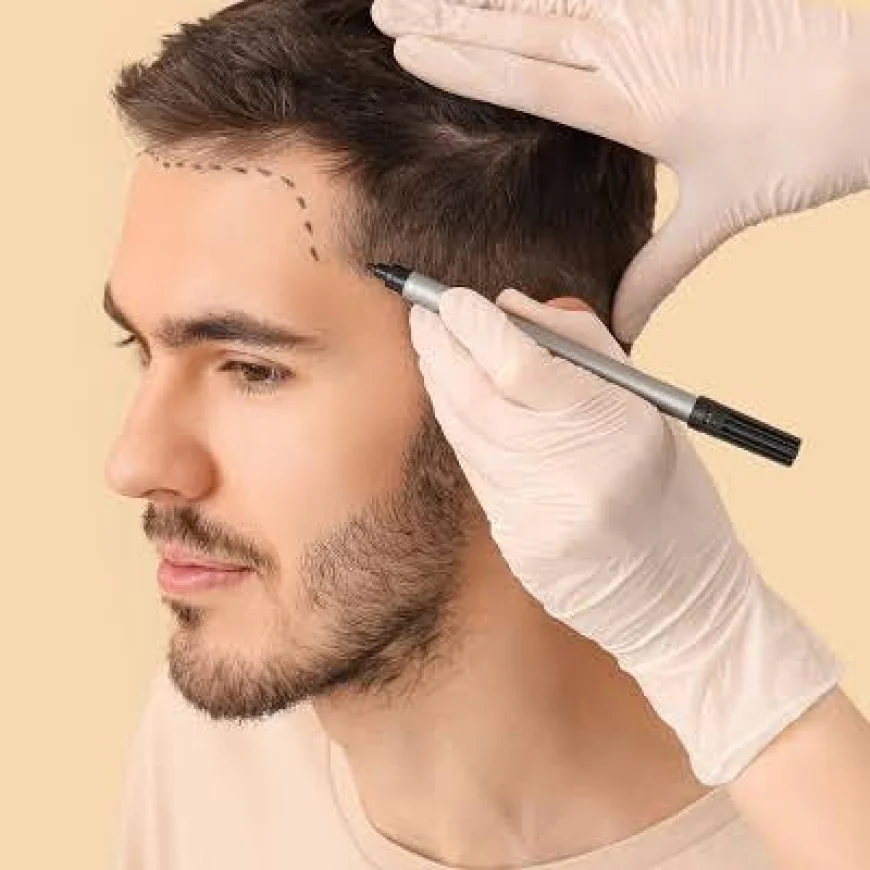 Hair Transplant in Dubai: Complete Guide to Natural Hair Restoration