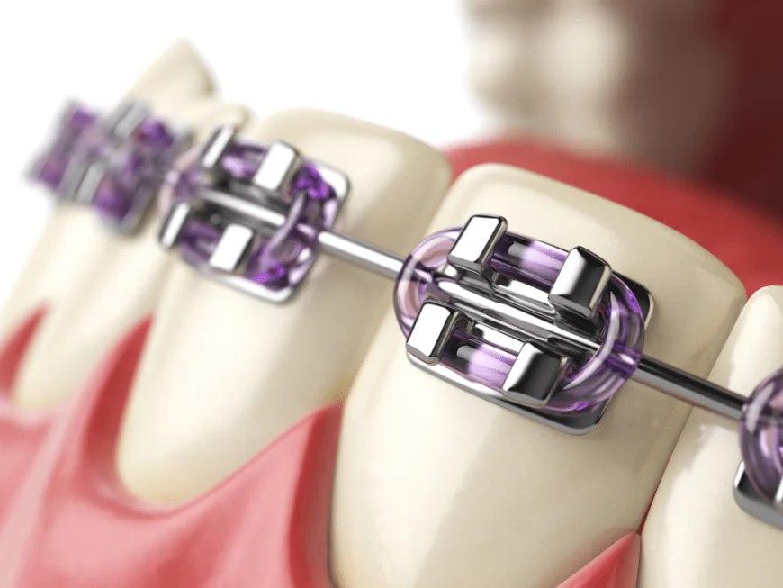 Affordable Orthodontics and Dental Implants Near Me: Your Guide to a Healthier, Confident Smile