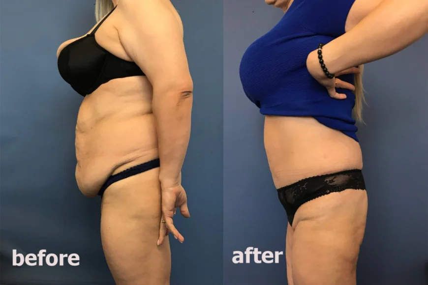 How Modern Tummy Tuck Approaches Consider Individual Lifestyle Factors
