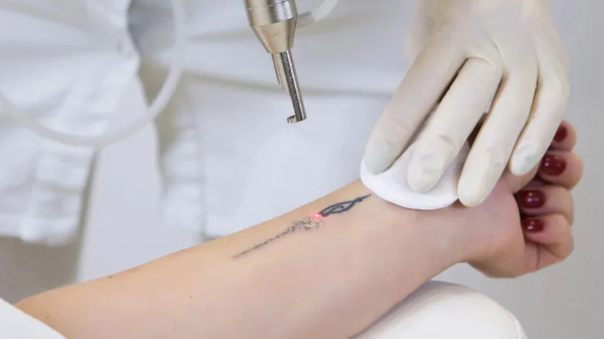 Laser Tattoo Removal in North Vancouver That Gives Your Skin a Fresh Start